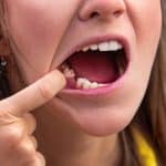 Fini les trous dans la dentition, les Japonais ont trouvé un médicament pour faire repousser les den...